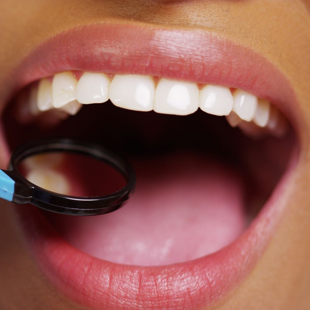 Bouche ouverte d'une personne, avec un miroir dentaire.