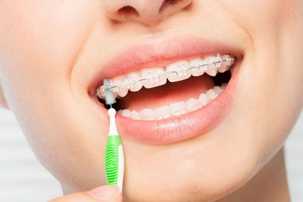 Una mujer con aparatos ortopédicos se cepilla los dientes con un cepillo interdental.