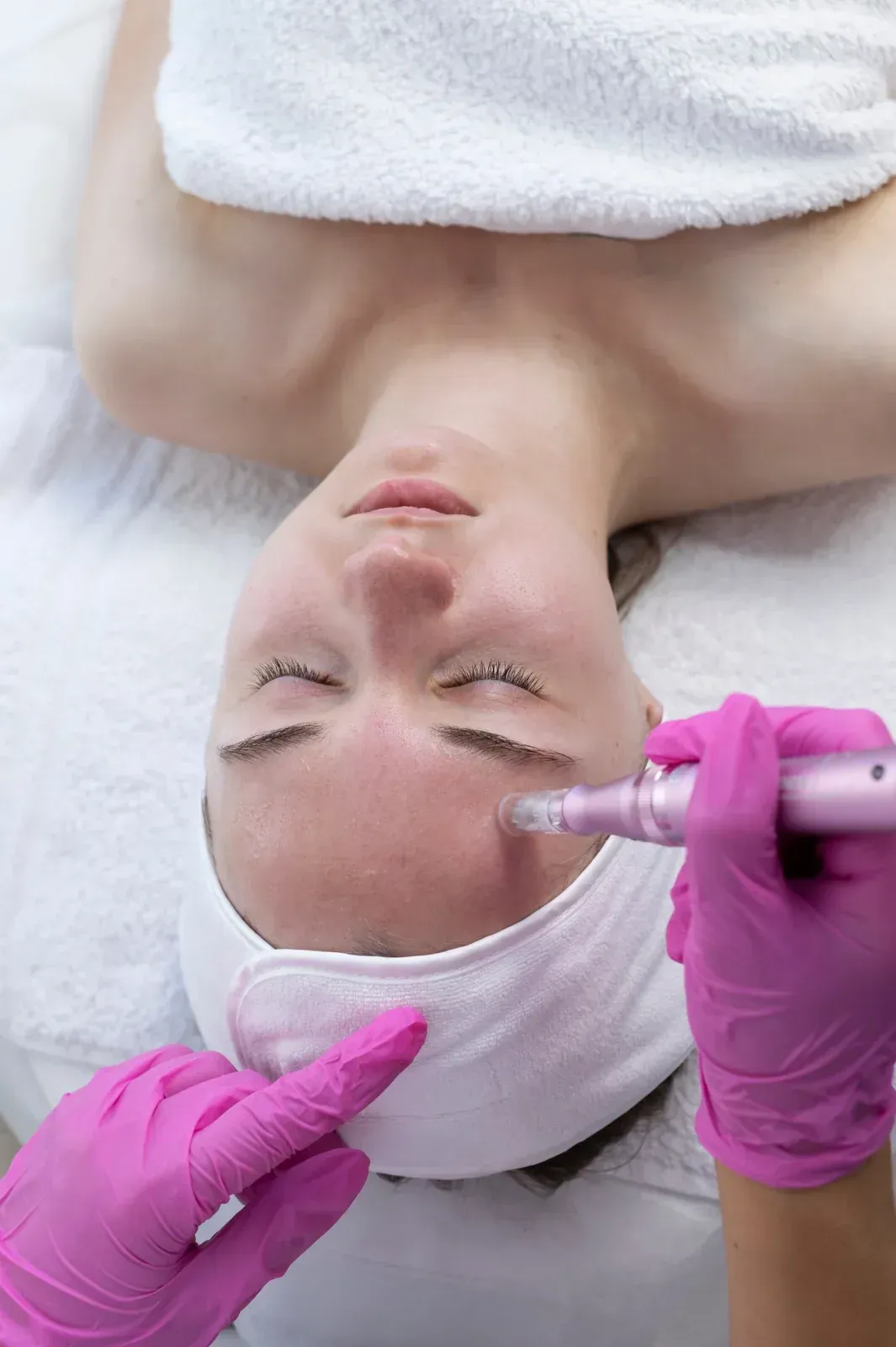 Persona recibiendo tratamiento de microagujas facial. Manos con guantes rosas sostienen el dispositivo cerca de la frente.