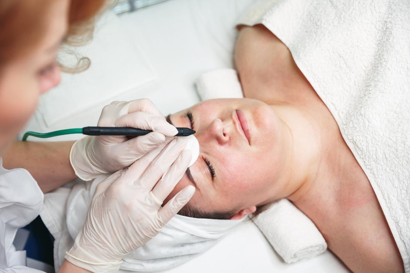 Electrodepilacion facial en Madrid