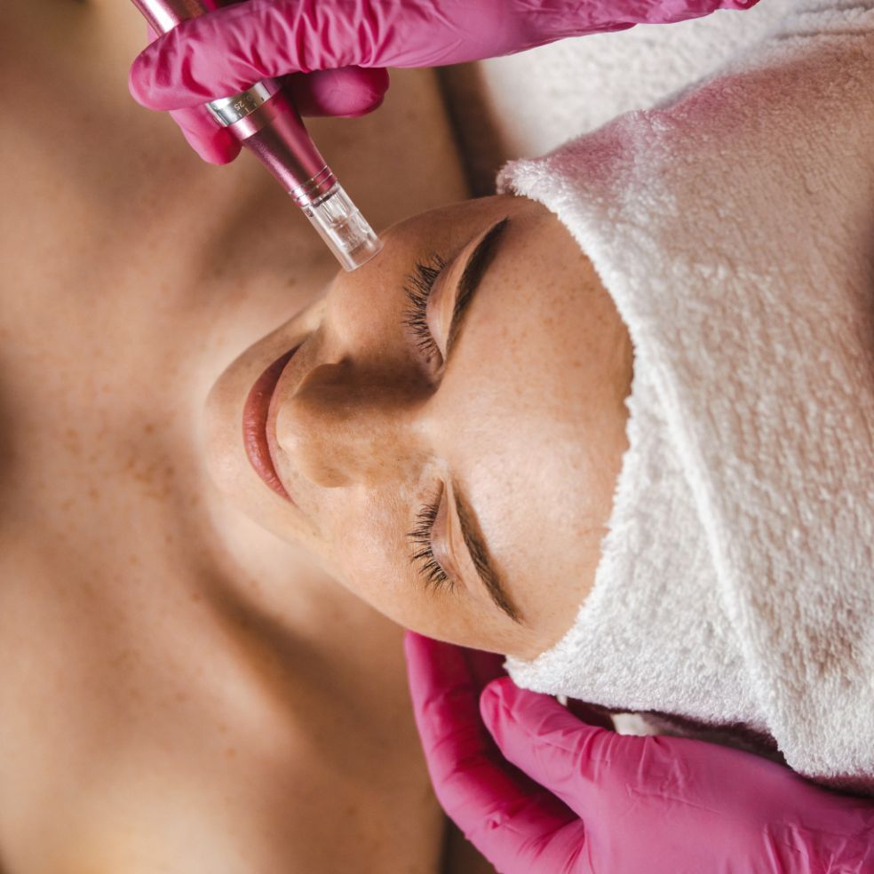 Micropuntura Dermapen en Madrid