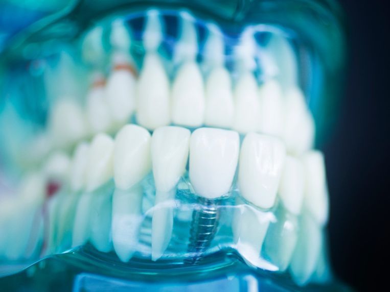 Un primer plano de un modelo dental con un implante dental en él.