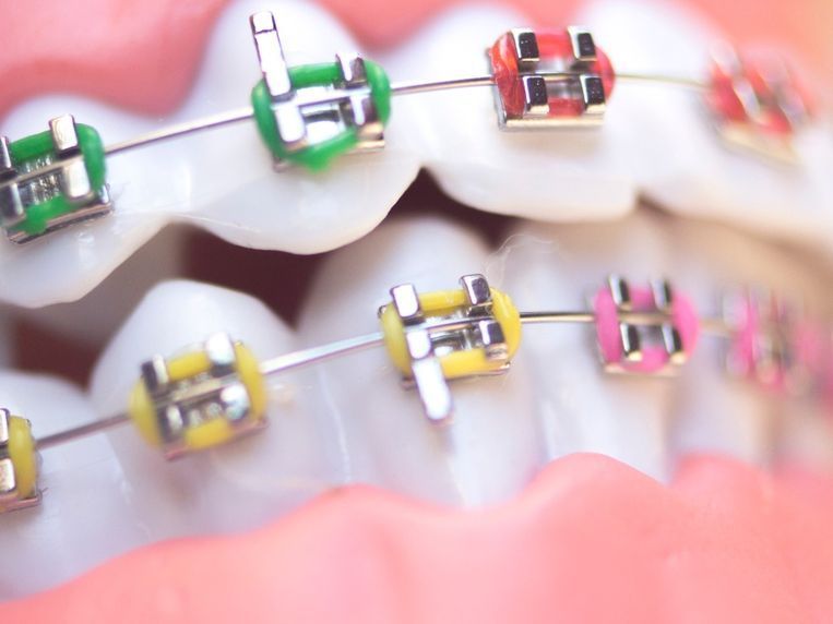 Un primer plano de los dientes de una persona con aparatos ortopédicos.