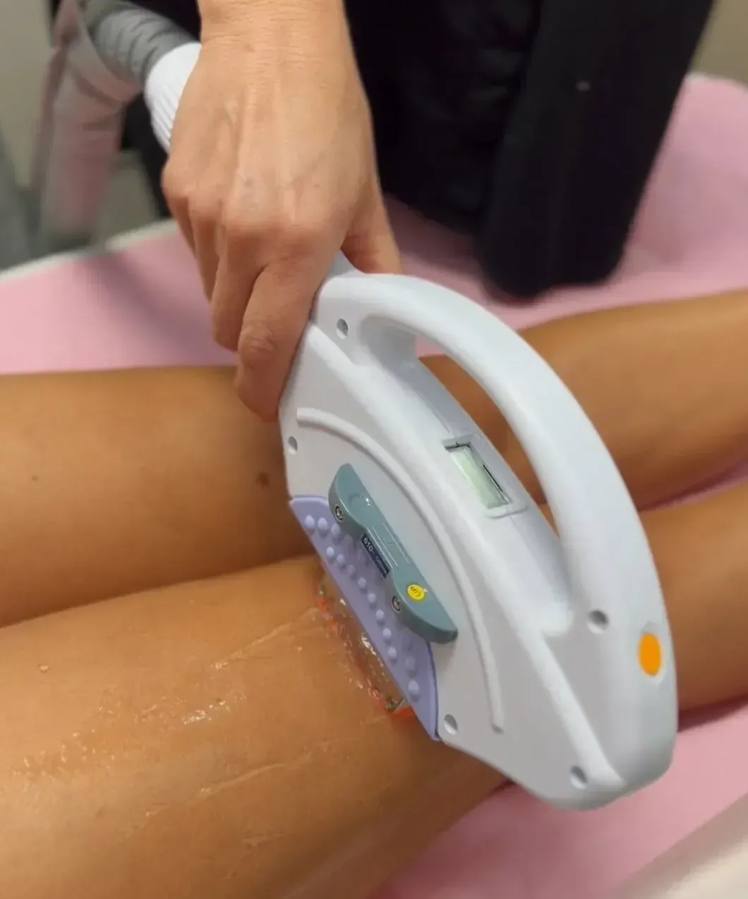 Pierna de una persona siendo tratada con un dispositivo de depilación láser.