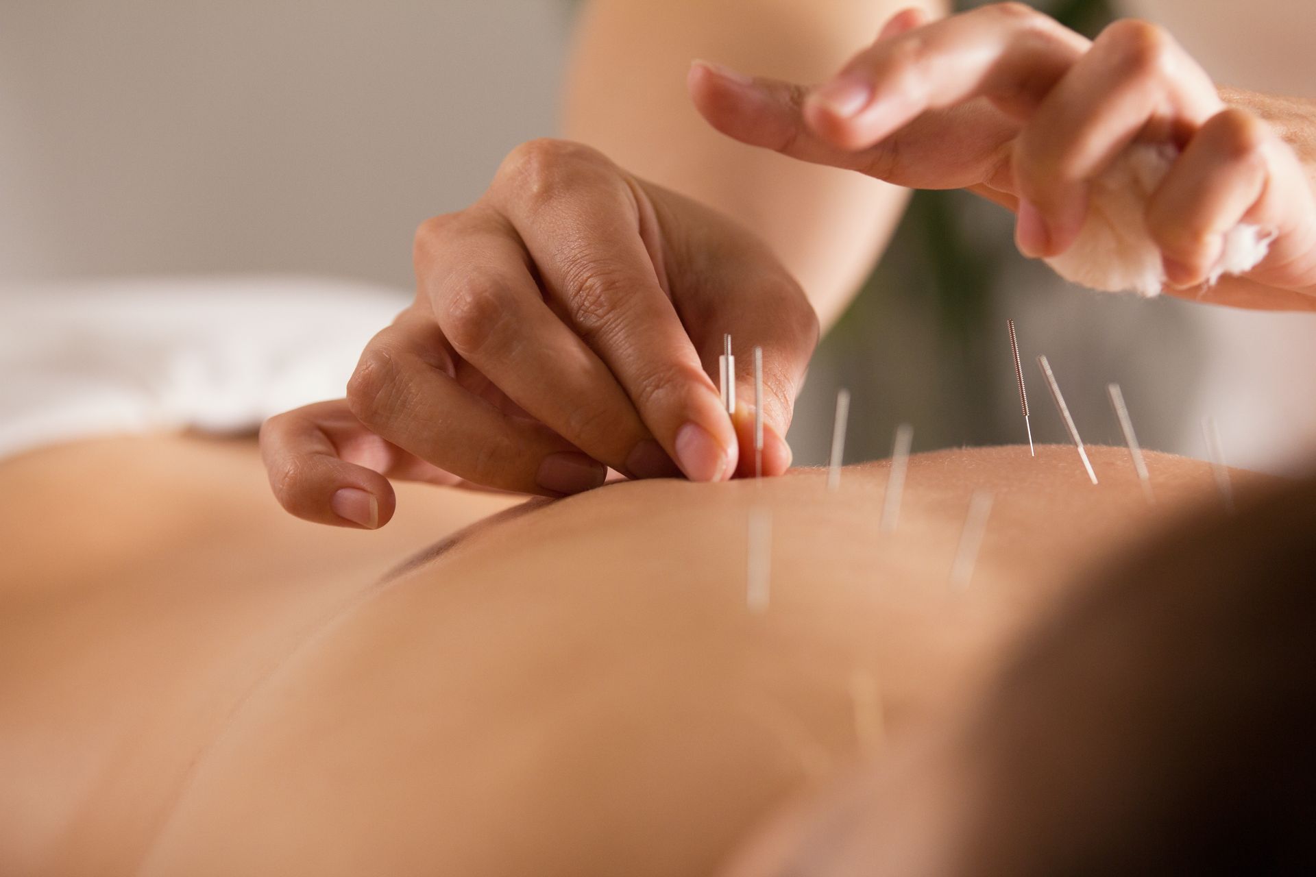 Une femme reçoit de l'acupuncture sur le dos.