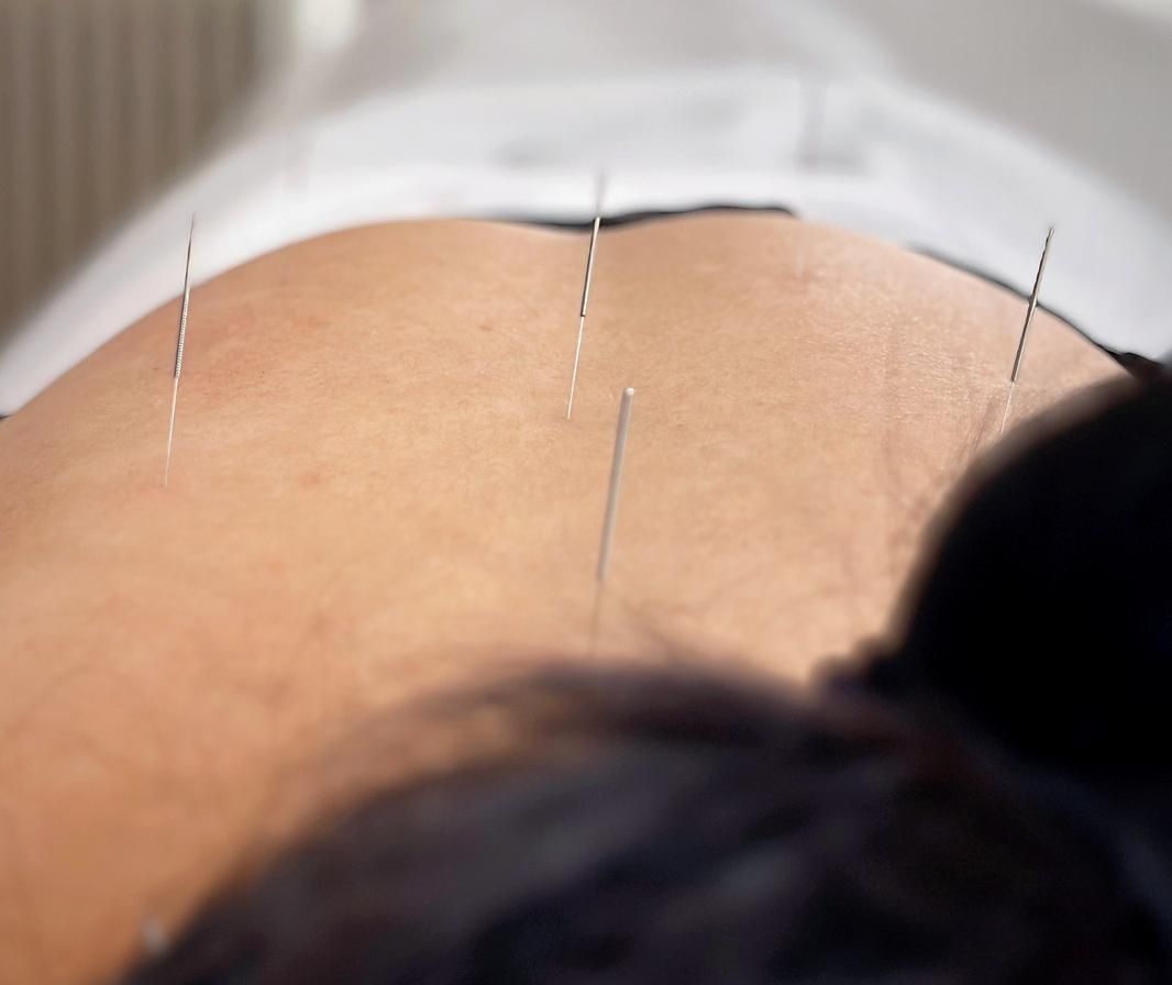 Une femme reçoit de l'acupuncture sur le dos.