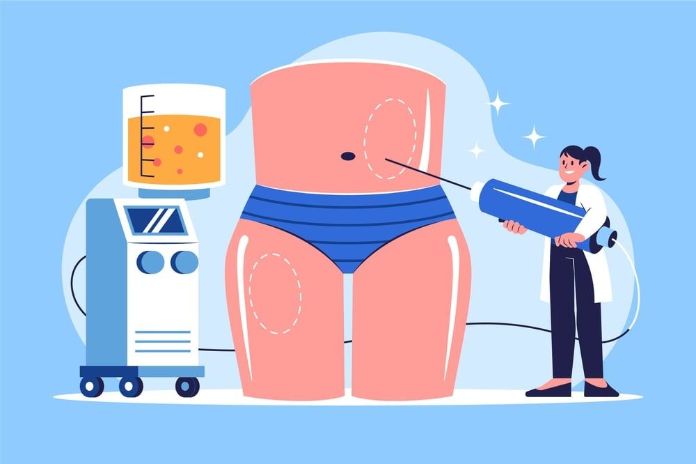 Illustration: Ein Arzt führt eine Körperformungsbehandlung an einem Patienten durch. Geräte und Flüssigkeiten sind zu sehen.