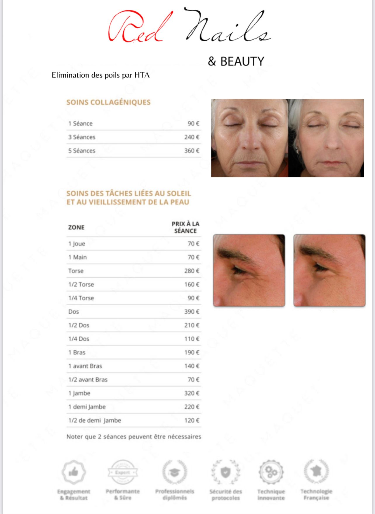 Épilation définitive visage