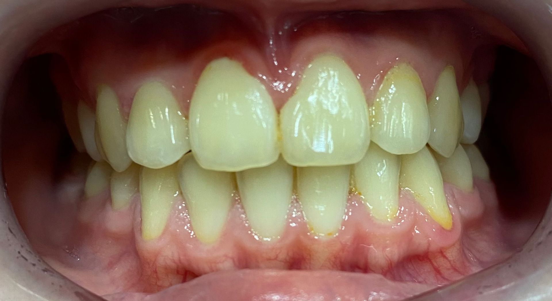 Un primer plano de los dientes y las encías de una persona.