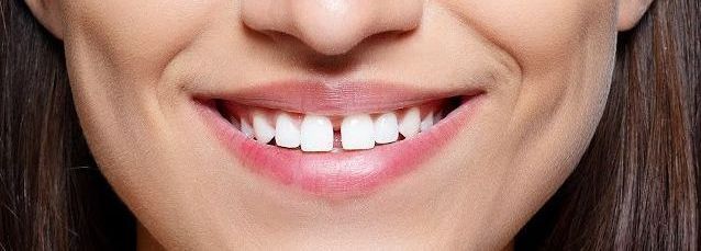 Un primer plano de la sonrisa de una mujer con un diente faltante.