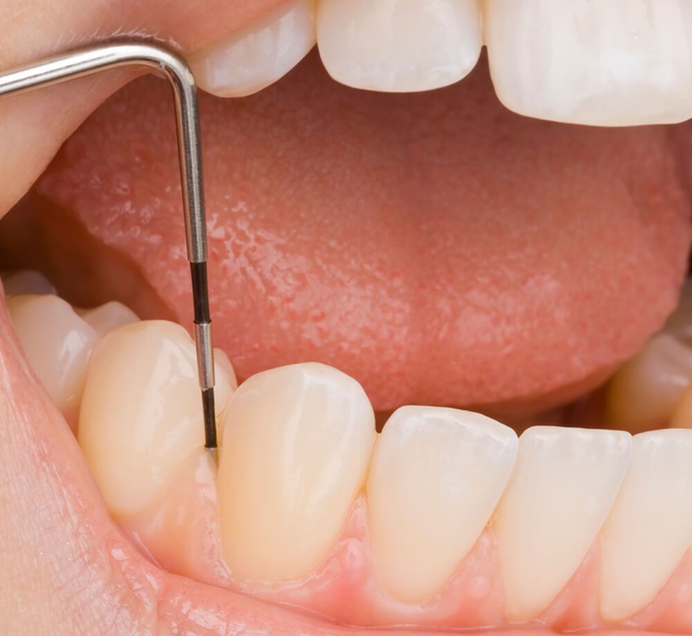 Una persona se está haciendo examinar los dientes por un dentista.