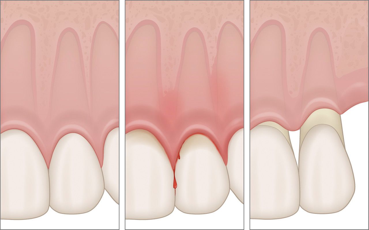 Tres imágenes de los dientes de una persona que muestran diferentes etapas de la enfermedad de las encías.