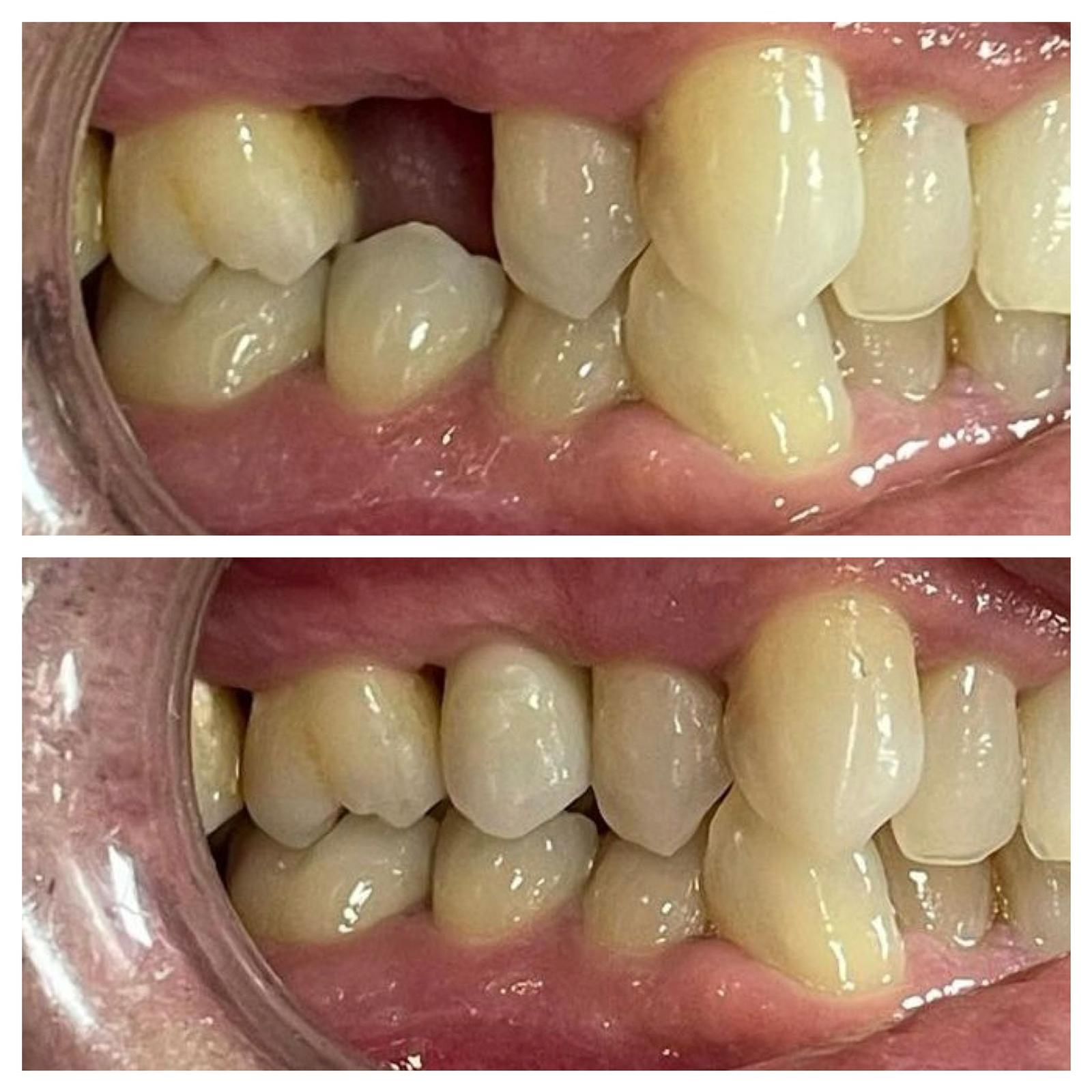 Una fotografía de antes y después de los dientes de una persona.