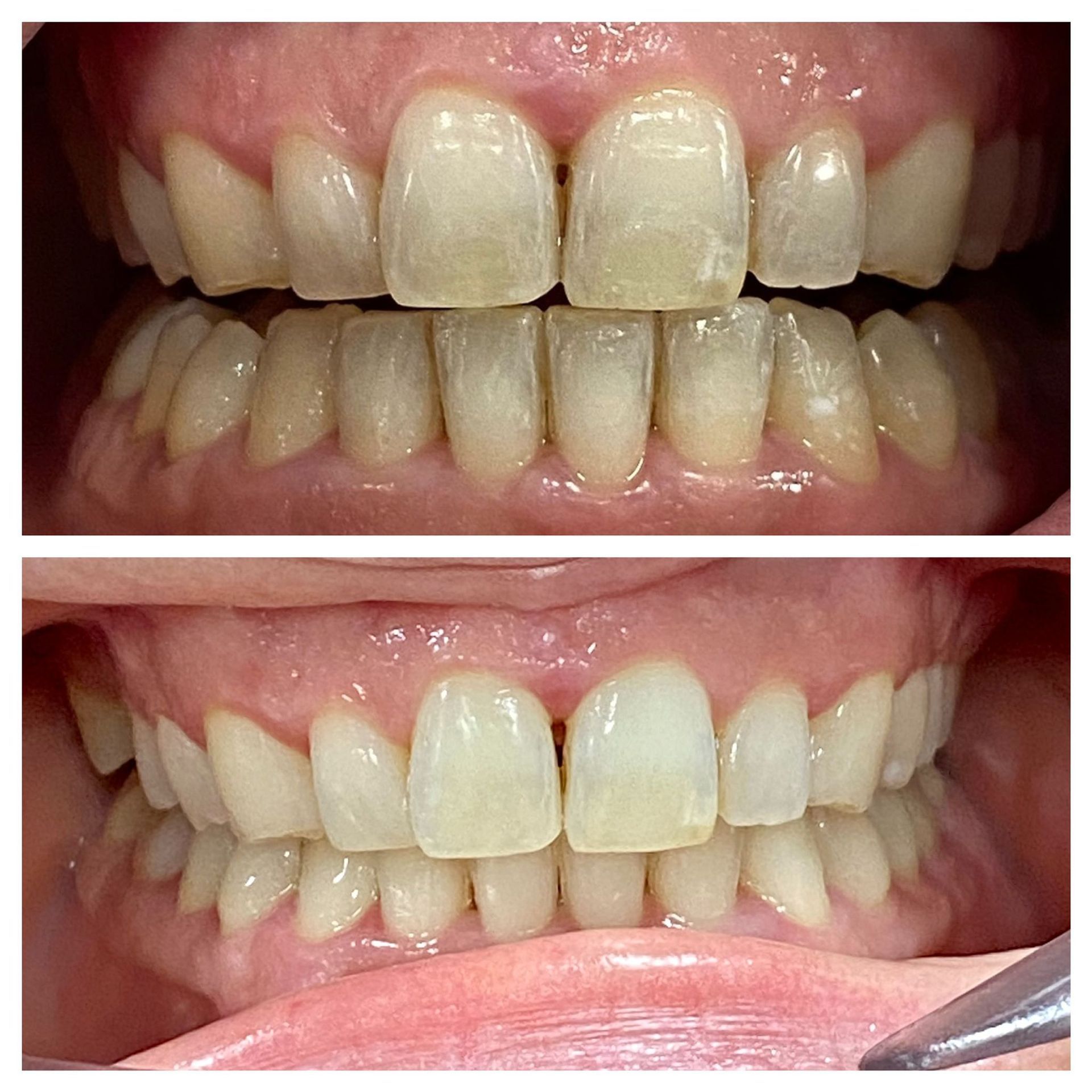 Una fotografía de antes y después de los dientes de una persona.