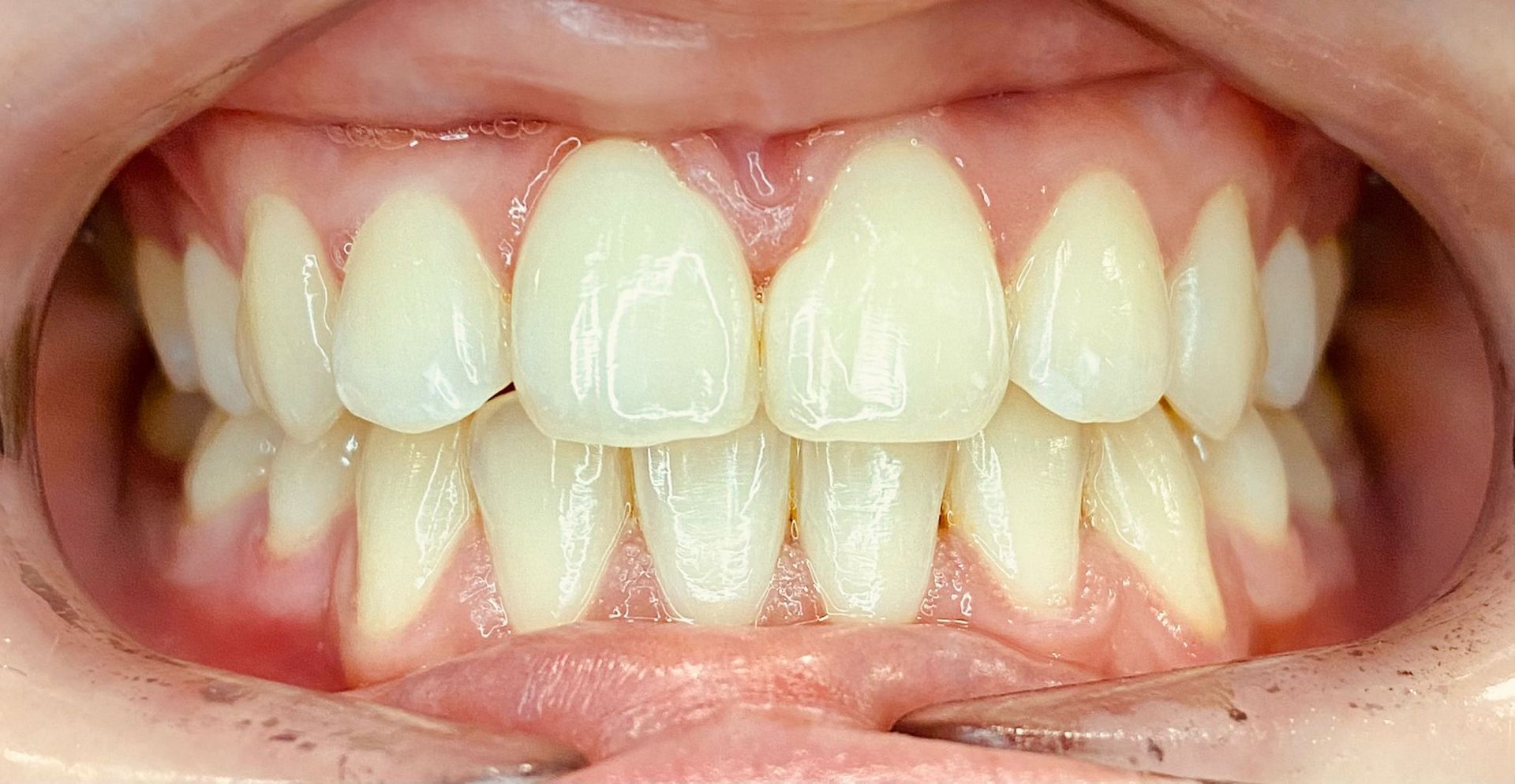 Un primer plano de los dientes de una persona con dientes blancos.