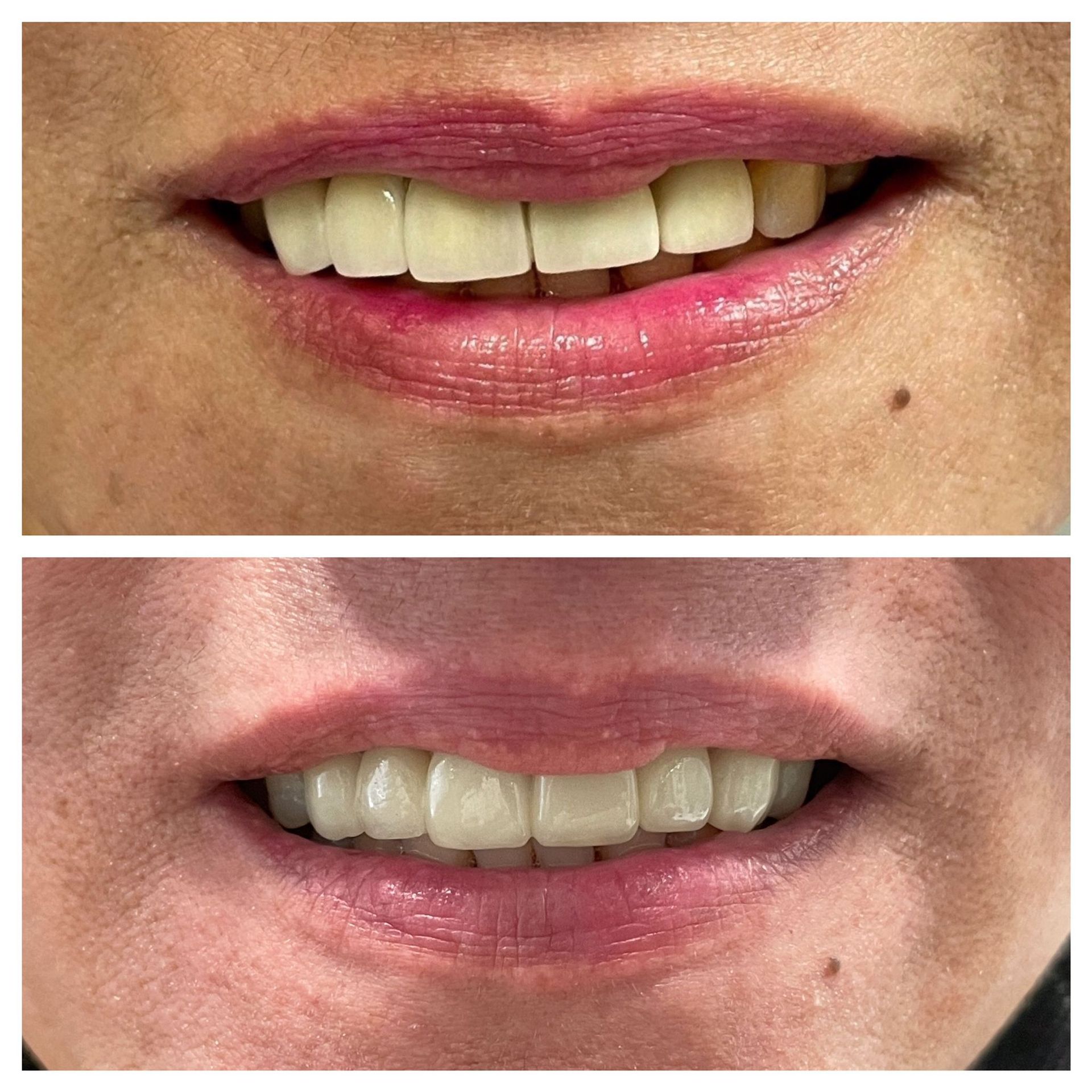 Un hombre con barba tiene una foto de sus dientes antes y después.