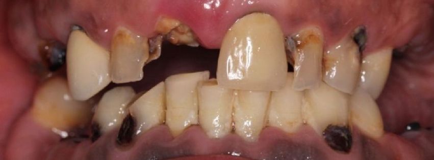 Un primer plano de los dientes de una persona con un diente roto.