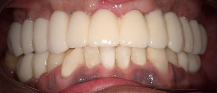 Un primer plano de los dientes de una persona con muchos dientes blancos.