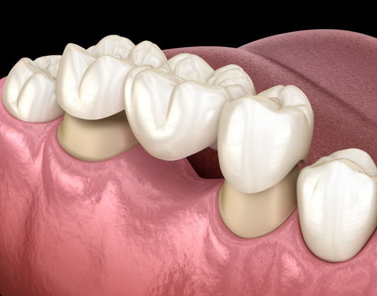 Una imagen generada por computadora de un puente dental en la boca de una persona.