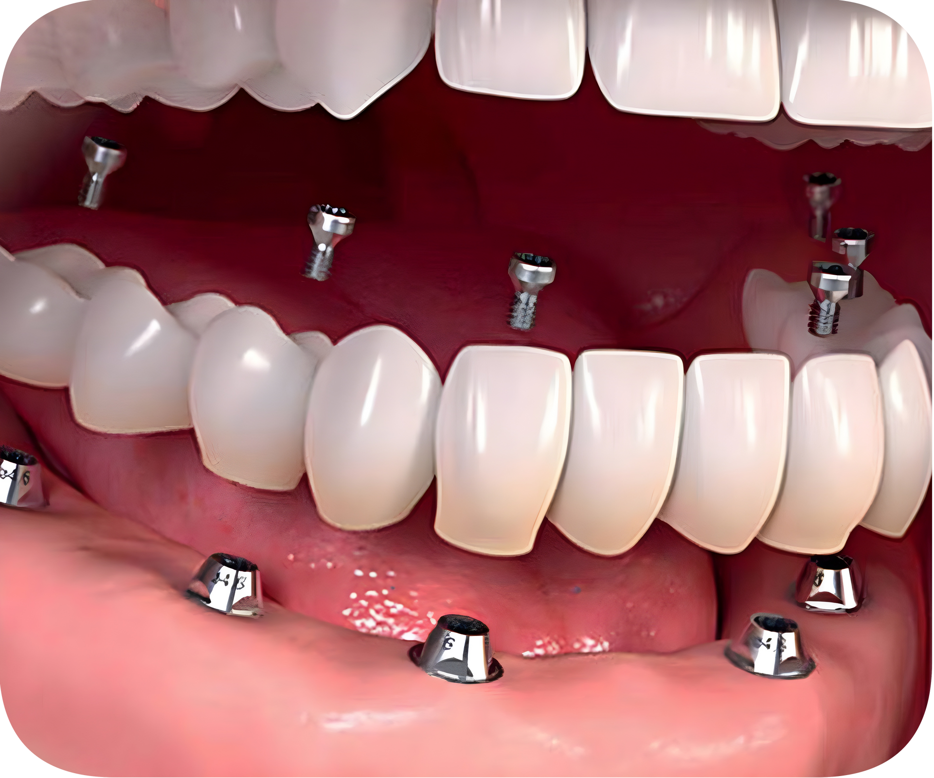 Un primer plano de los dientes de una persona con tornillos en ellos.