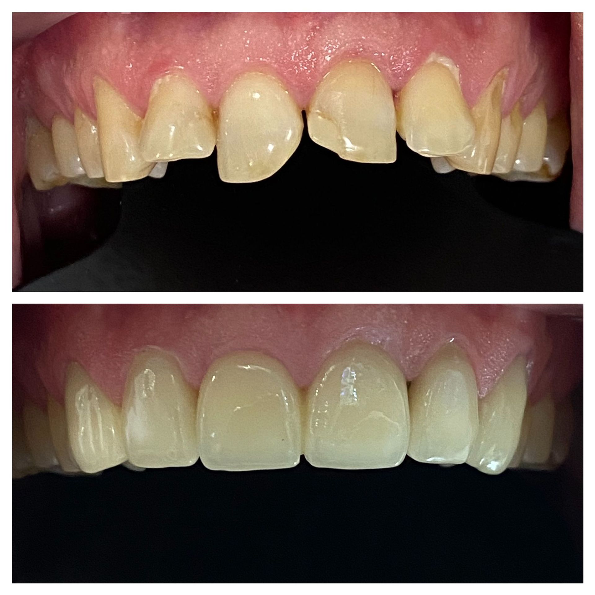 Una fotografía de antes y después de los dientes de una persona.