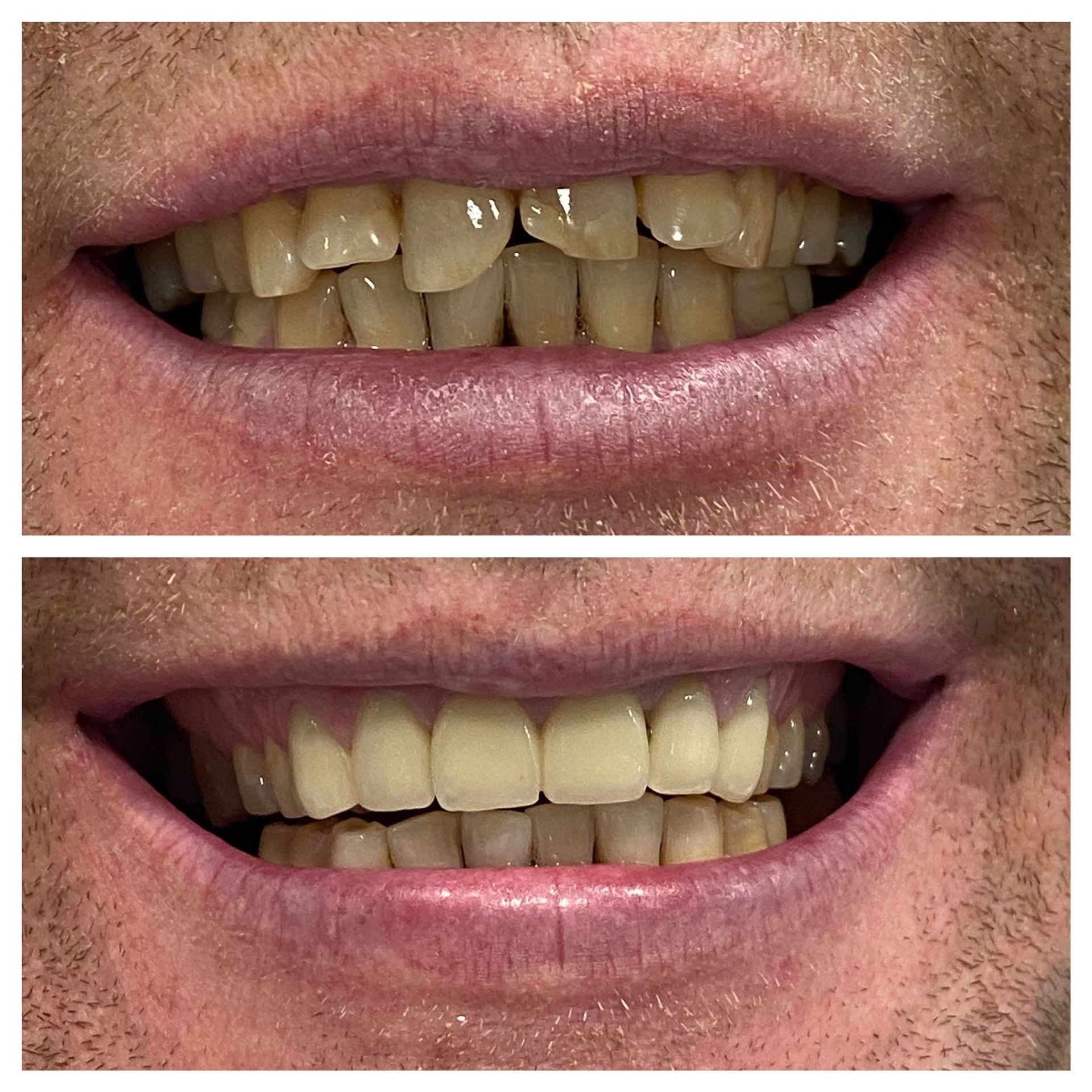 Una foto de antes y después de los dientes de un hombre.