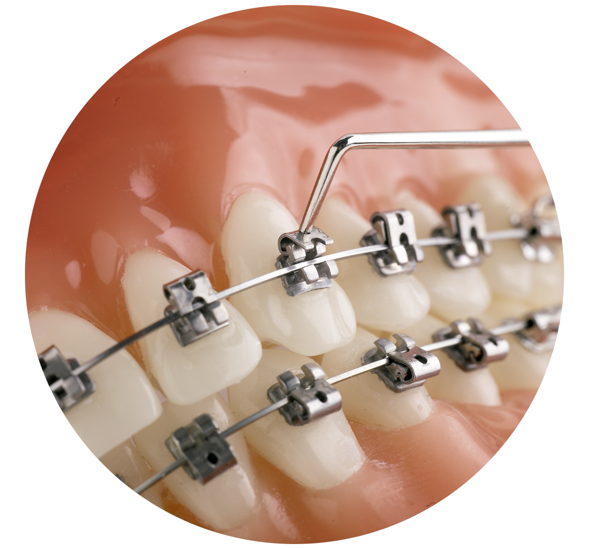 Los dientes de una mujer antes y después del blanqueamiento.