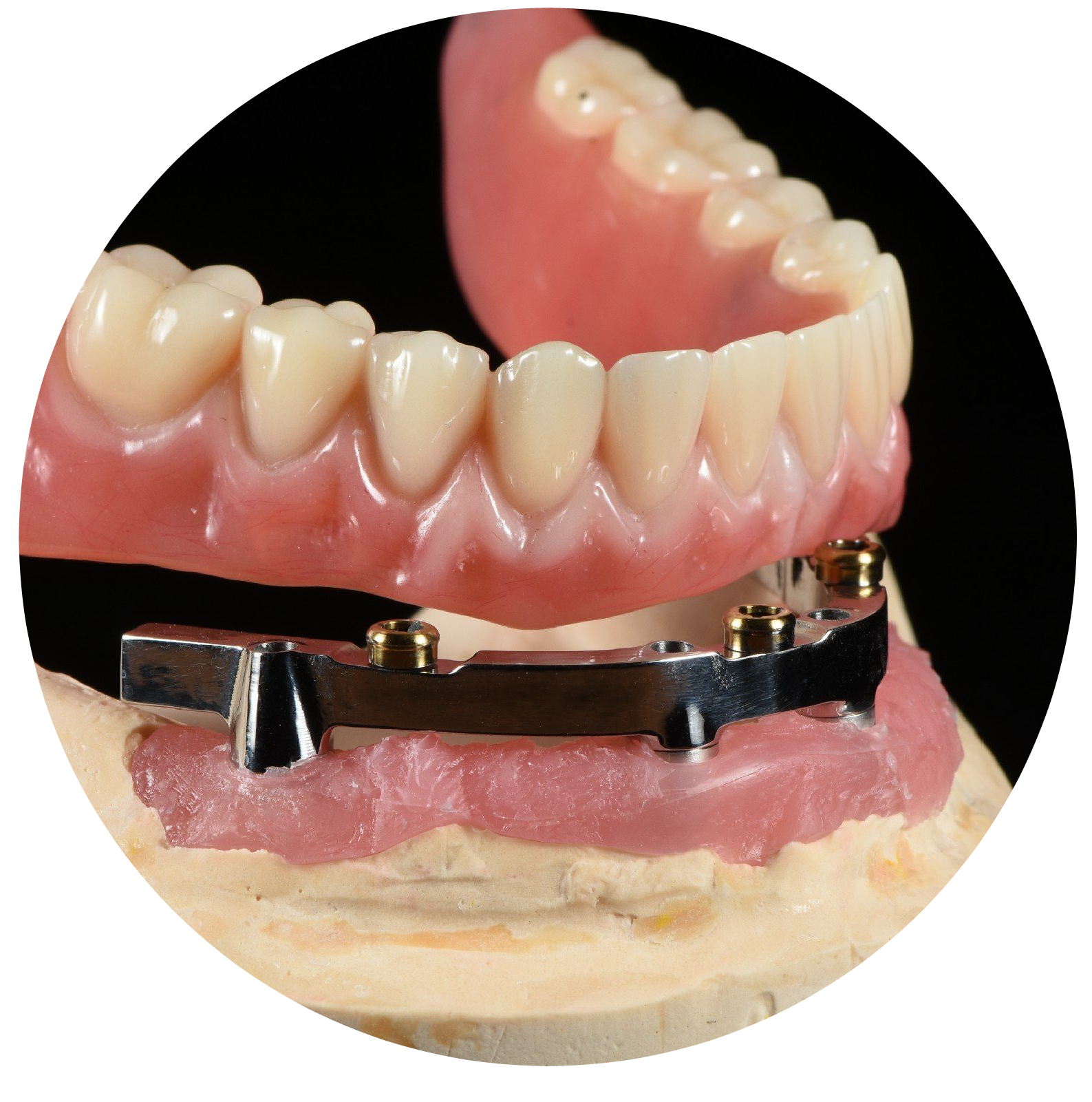 Un primer plano de una dentadura postiza con un soporte de metal unido a ella.