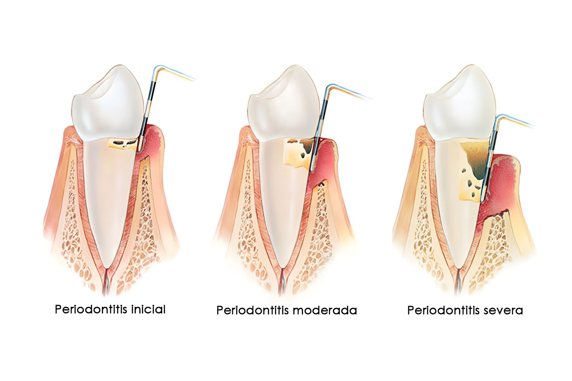 Un diagrama de las etapas de la periodontitis en los dientes de una persona.