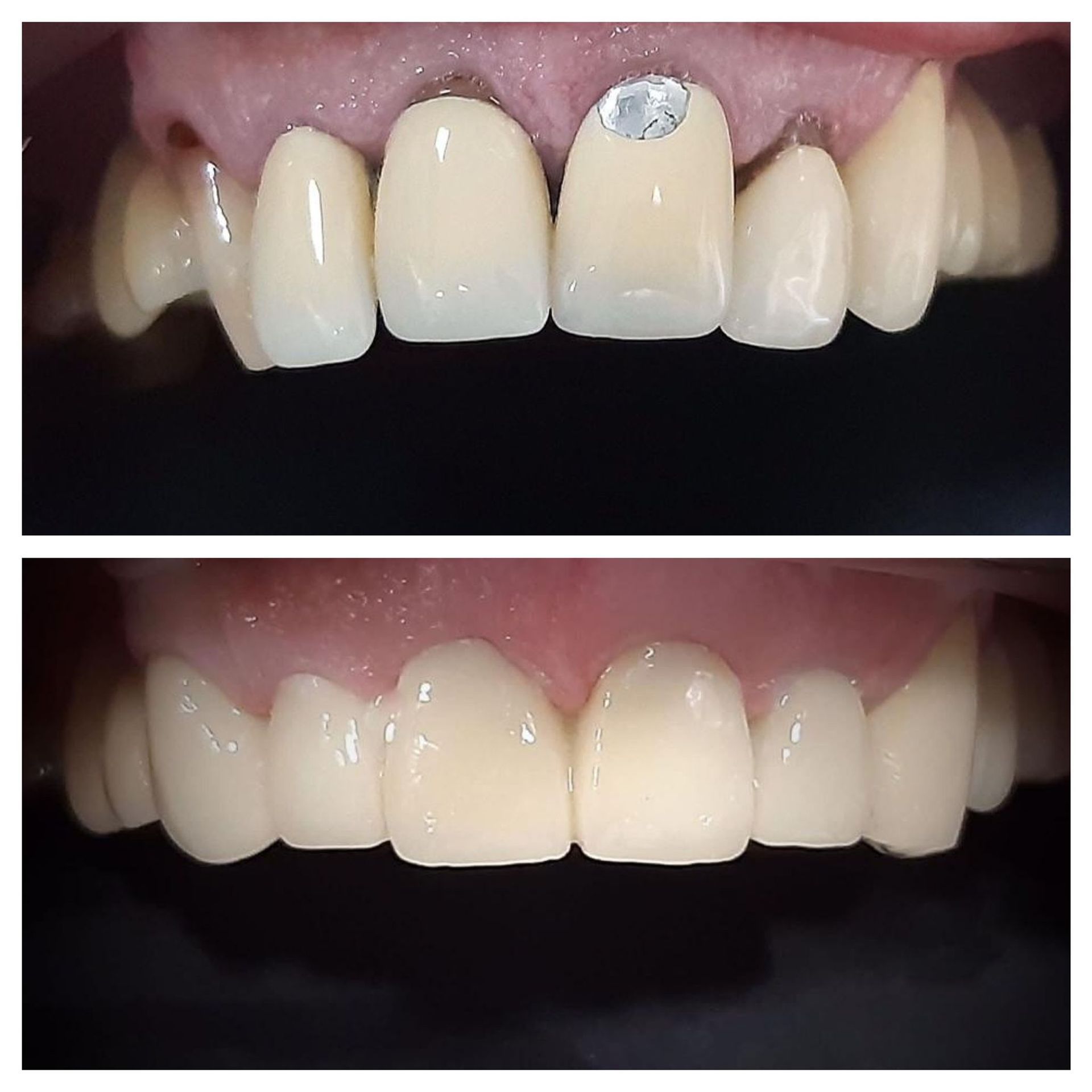 Una fotografía de antes y después de los dientes de una persona.