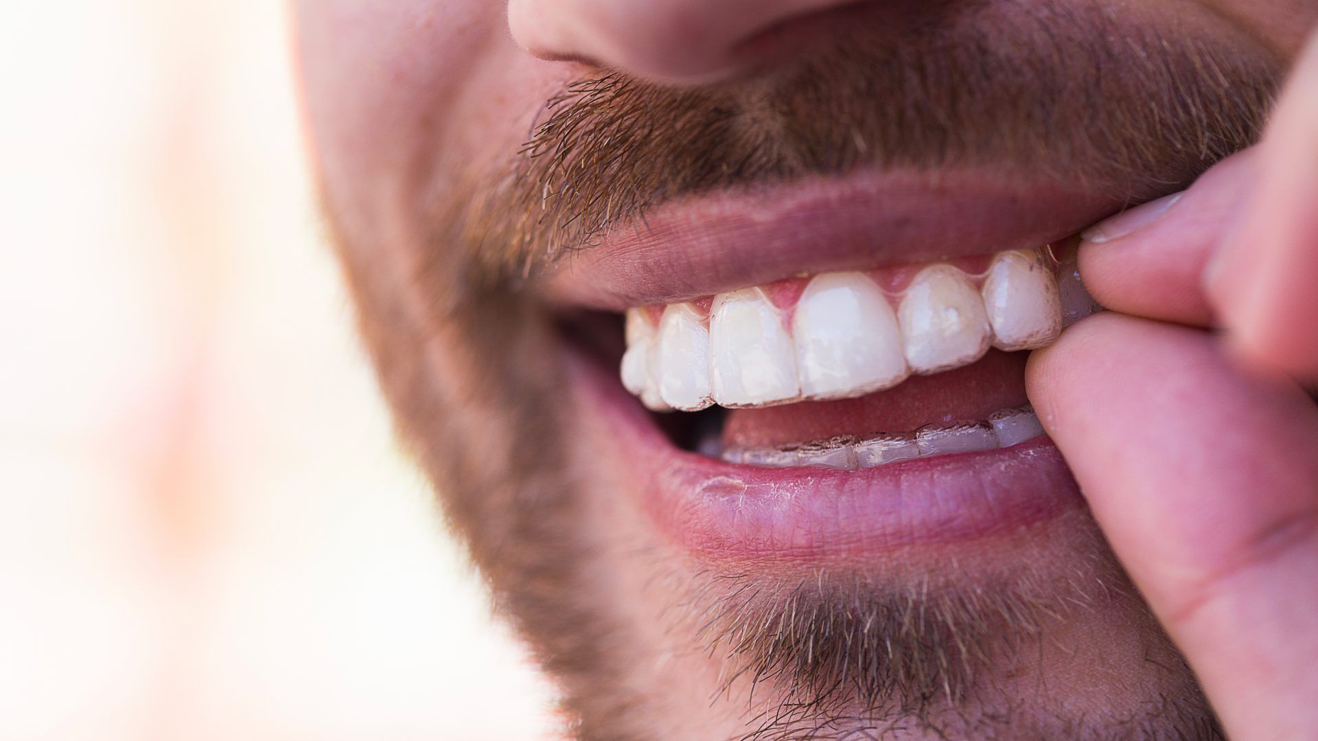 Los dientes de una mujer antes y después del blanqueamiento.
