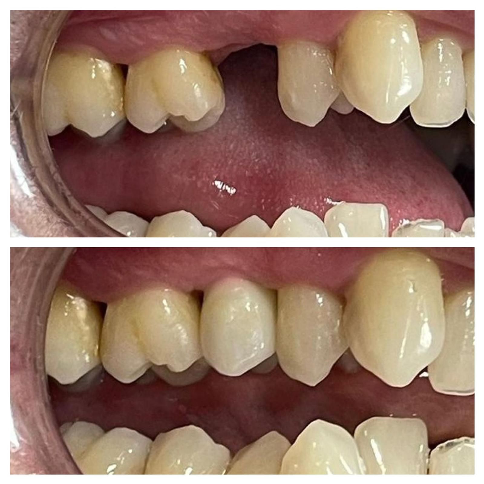 Una fotografía de antes y después de los dientes de una persona.