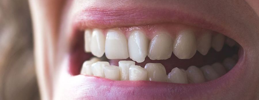 Un primer plano de los dientes de una mujer con la boca abierta.