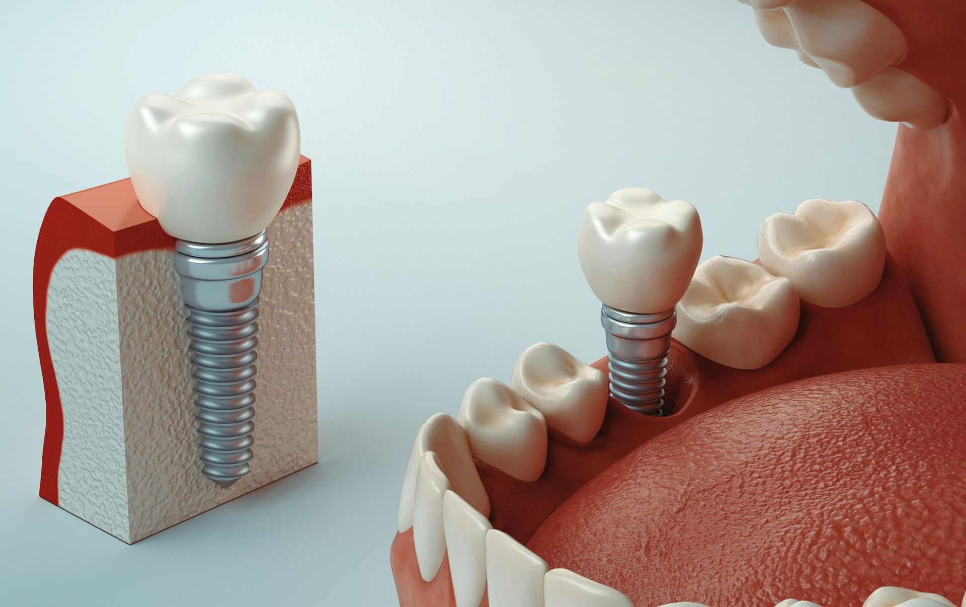 Un modelo de un diente con un implante dental en él.
