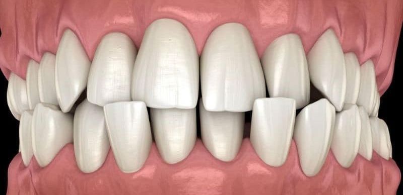 Un primer plano de los dientes de una persona con un fondo negro.