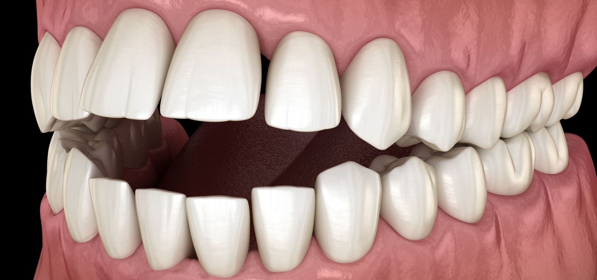 Un primer plano de los dientes de una persona con la boca abierta.