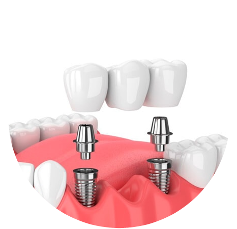 Una representación 3D de un puente dental con implantes dentales.