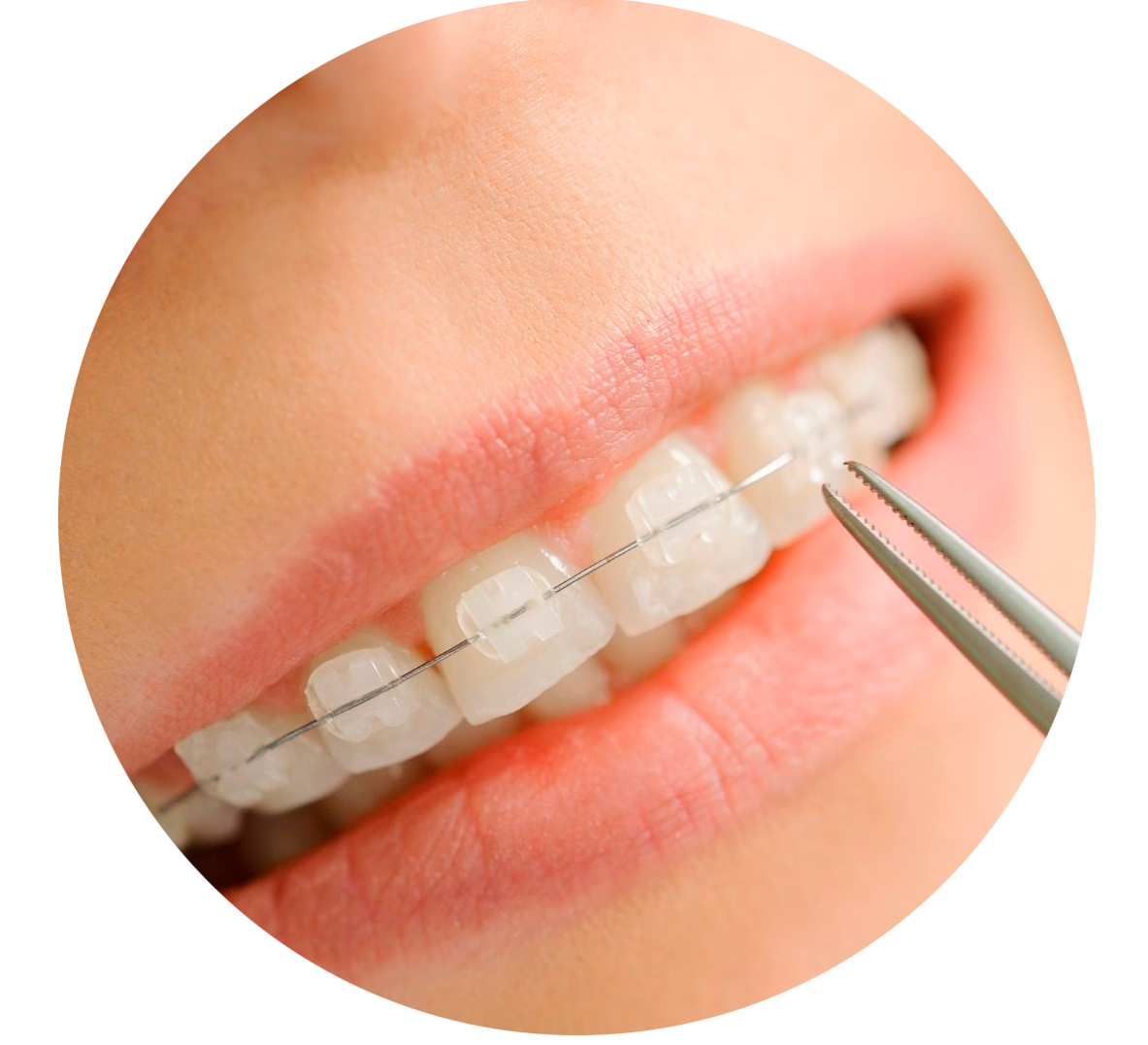 Los dientes de una mujer antes y después del blanqueamiento.