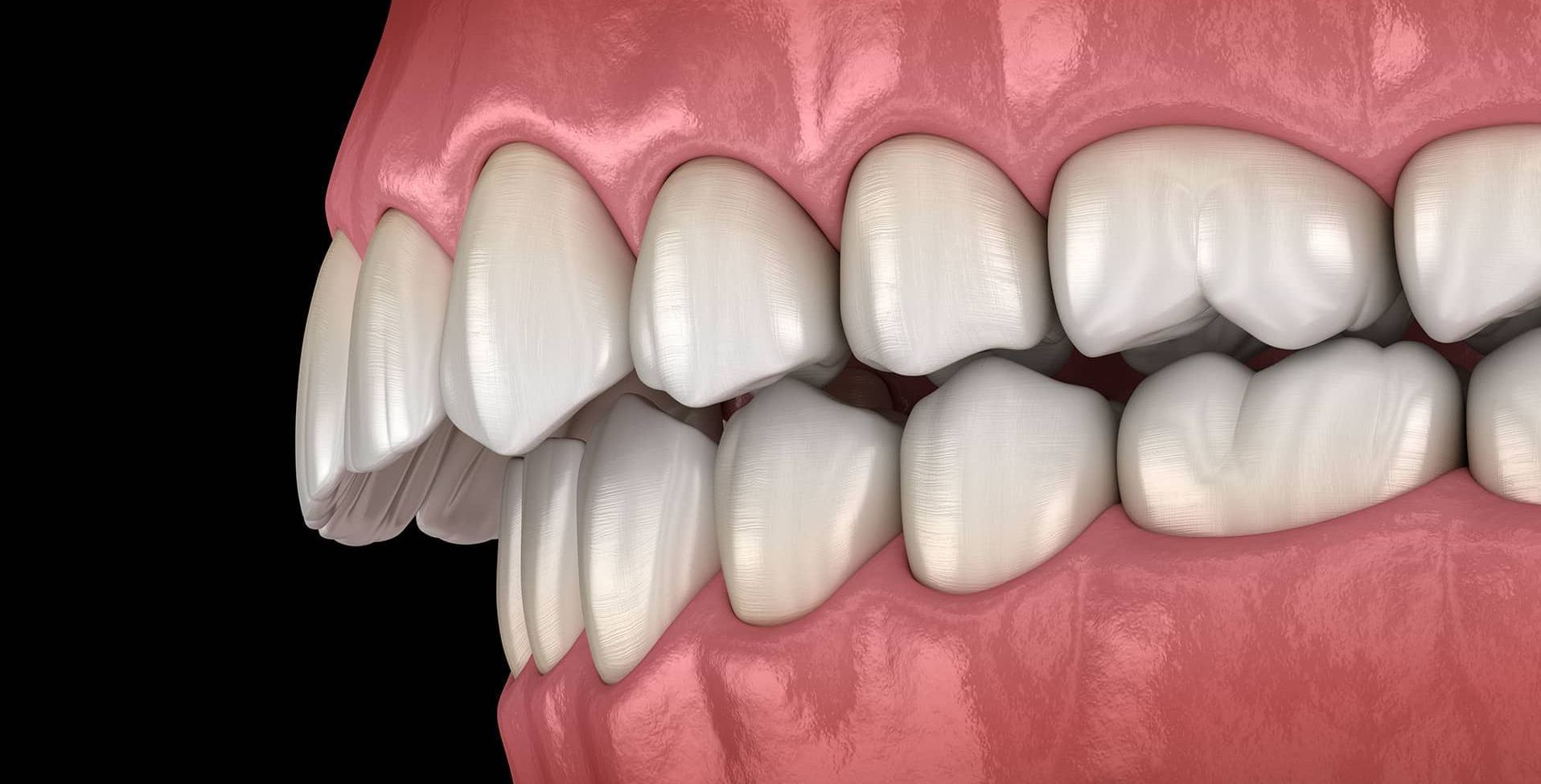 Un primer plano de los dientes y las encías de una persona sobre un fondo negro.
