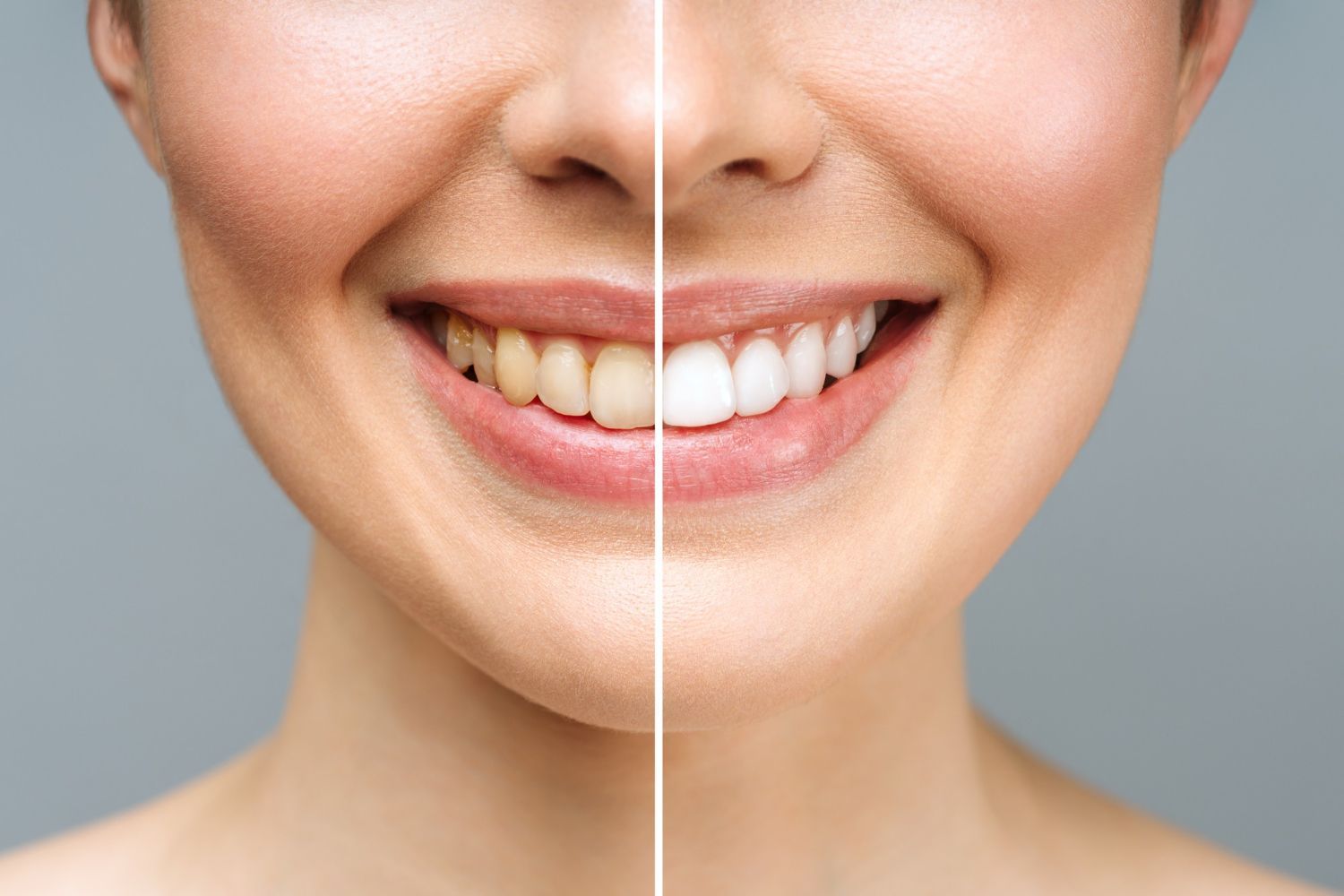 Los dientes de una mujer antes y después del blanqueamiento.