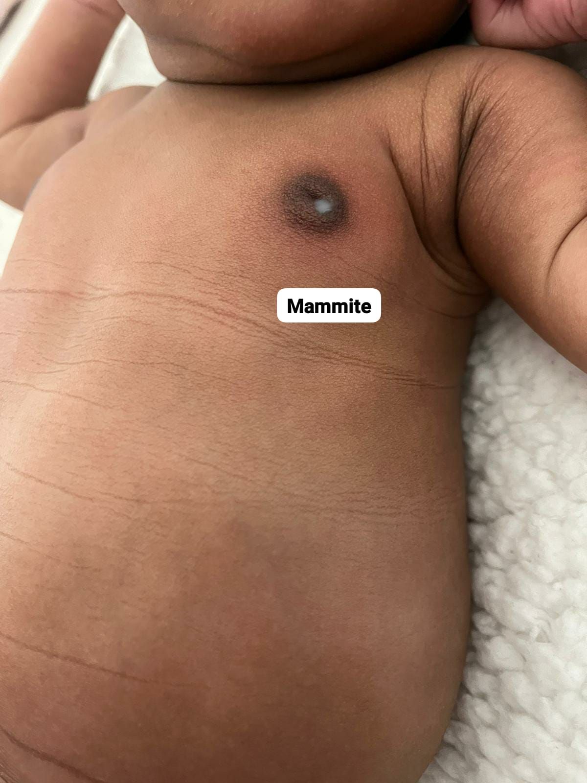 Bébé mamite