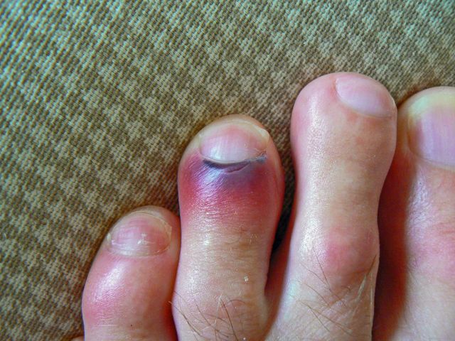 Golpe, moretón o hematoma en el pie, ¿qué debo hacer?