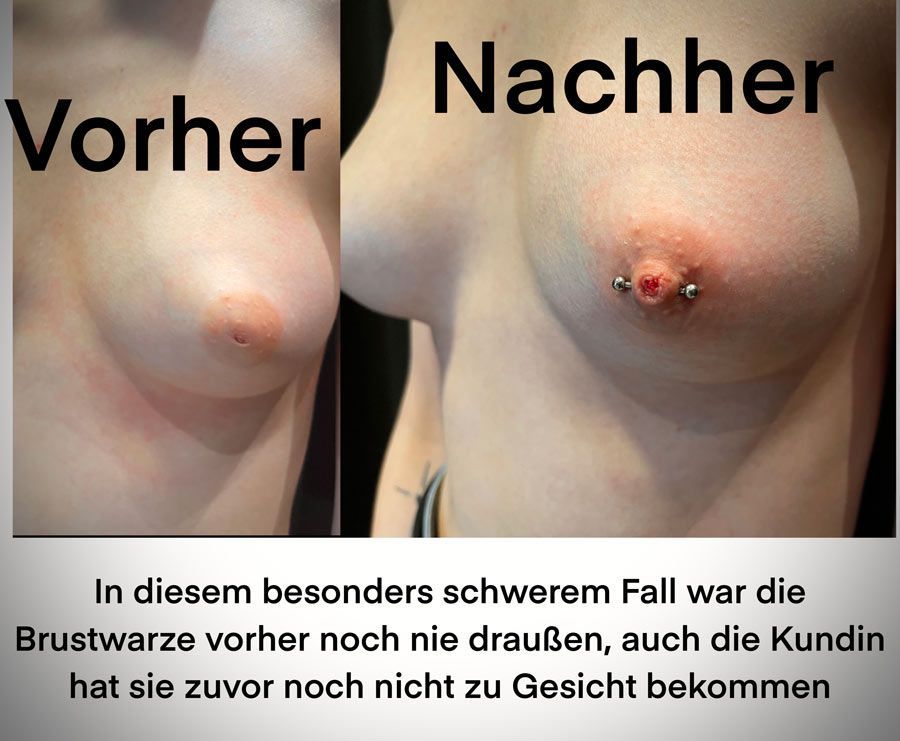 Brustwarzenpiercings. Vorher/nachher Vergleich