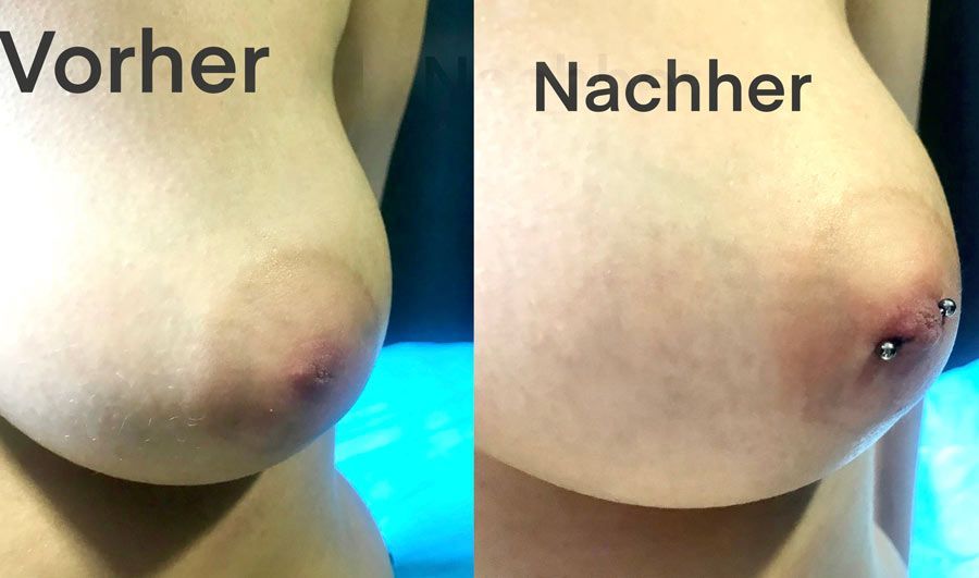 Brustwarzenpiercings. Vorher/nachher Vergleich