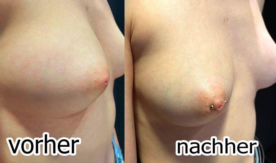 Brustwarzenpiercings. Vorher/nachher Vergleich