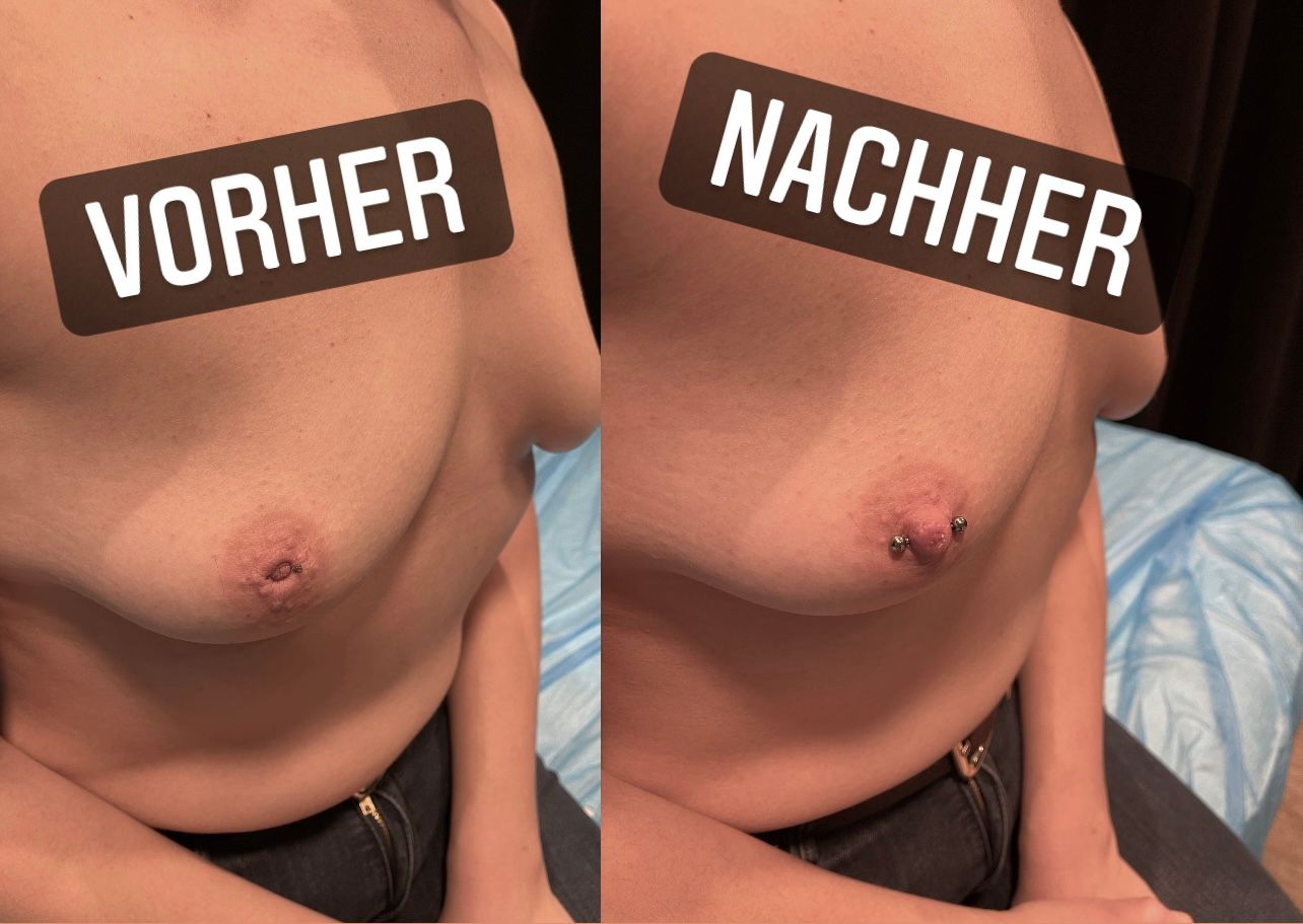 Brustwarzenpiercings. Vorher/nachher Vergleich