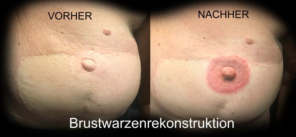 Brustwarzenpiercings. Vorher/nachher Vergleich