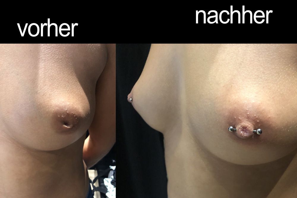 Brustwarzenpiercings. Vorher/nachher Vergleich