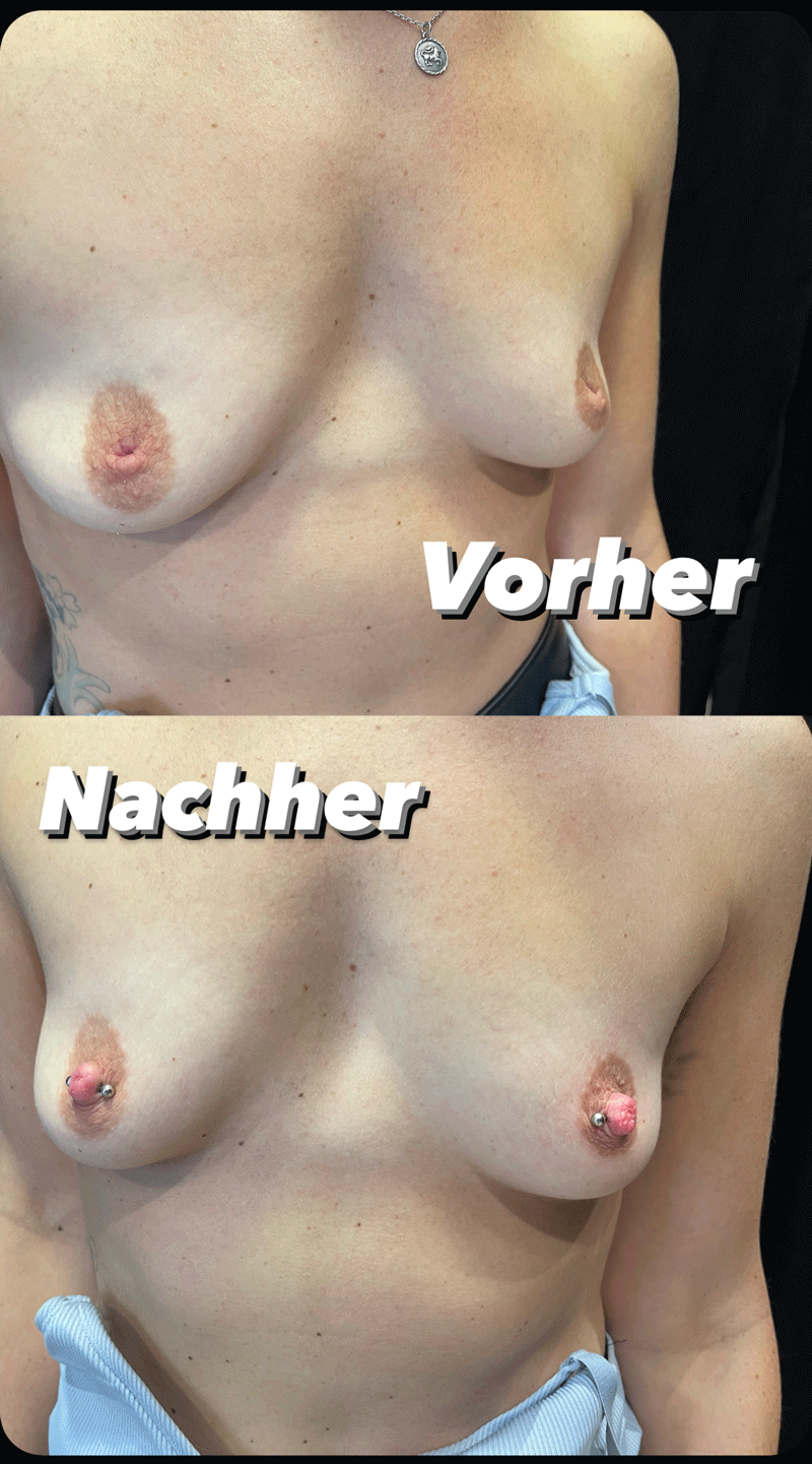 Brustwarzenpiercings. Vorher/nachher Vergleich