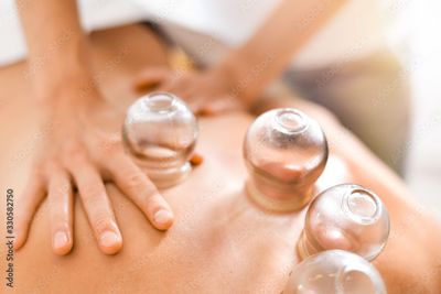 Massagetherapeutin setzt einer Person beim Schröpfen Gläser auf den Rücken